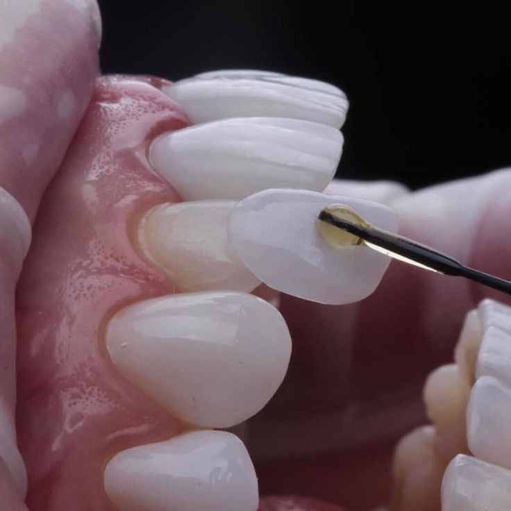 Lentes de contato dental